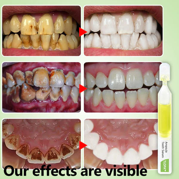 š„TLOPA⢠Ampoule Toothpaste, Removal of tartar and plaque bacteria and various oral problems